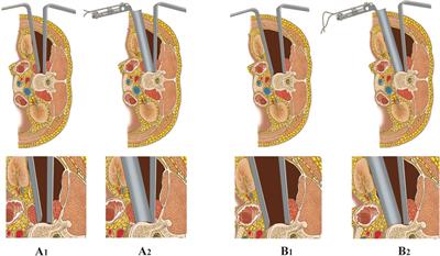 Comparison of mini-open, anteroinferior psoas approach and mini-open, direct lateral transpsoas approach for lumbar burst fractures: A retrospective cohort study